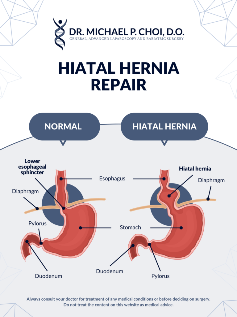 Normal vs hiatal hernia surgery cost