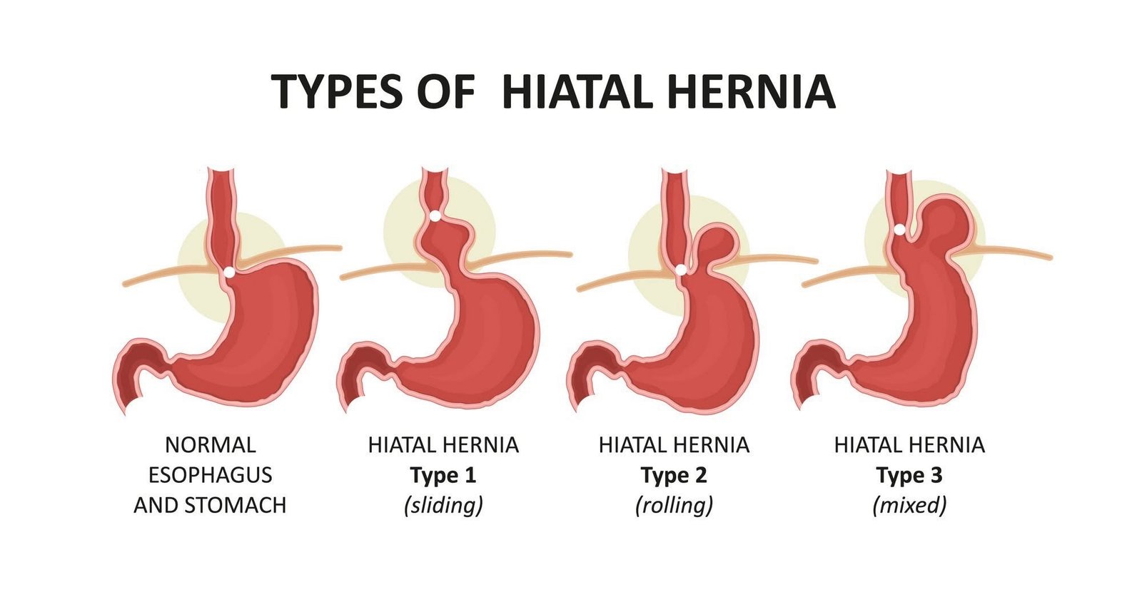 Hiatal Hernia Types Explained: Sliding, Rolling, and Mixed